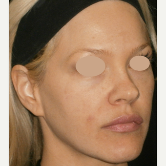 35-44 year old woman treated with IPL after 3125311
