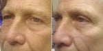63 Year Old Man Before and After Lower Eyelid Surgery before 712596