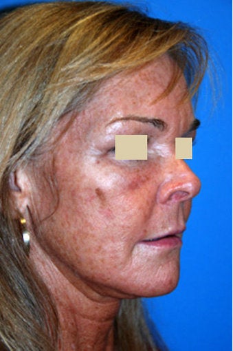 YoungVitalizer Procedure 166185