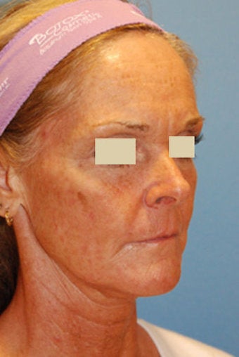 YoungVitalizer Procedure 166185