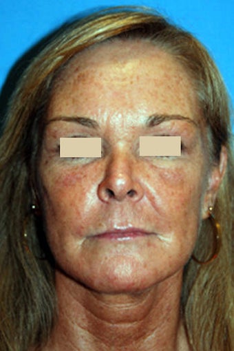 YoungVitalizer Procedure after 166185