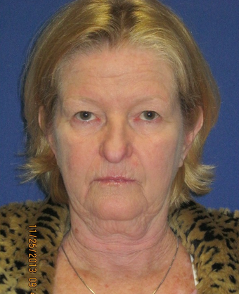 65 year old woman treated with Face Lift, Upper Lid Blepharoplasty, and Fractional CO2 Laser before 1774509