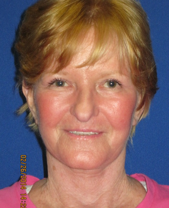 65 year old woman treated with Face Lift, Upper Lid Blepharoplasty, and Fractional CO2 Laser after 1774509
