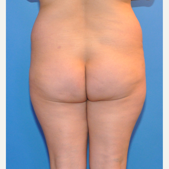 Brazilian Butt Lift before 3425586