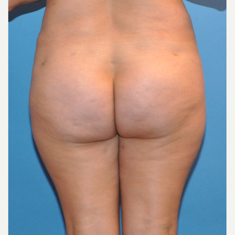 Brazilian Butt Lift after 3425586