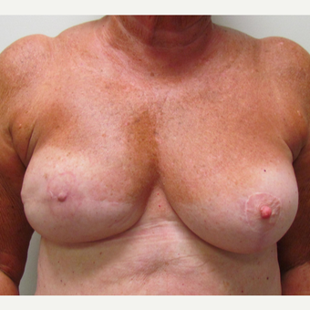 Nipple Surgery for This 74 Year Old Woman after 3387176