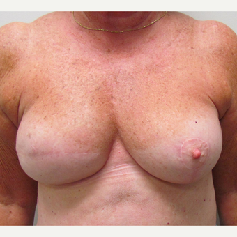 Nipple Surgery for This 74 Year Old Woman before 3387176