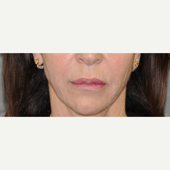 55-64 year old woman treated with Lip Lift before 3004951