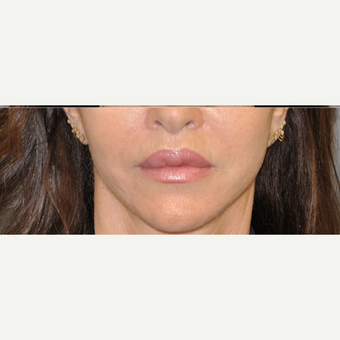 55-64 year old woman treated with Lip Lift after 3004951
