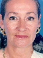 Facelift before 1047931