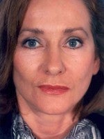 Facelift after 1047931