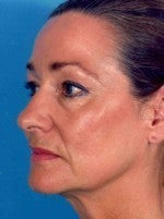 Facelift 1047931
