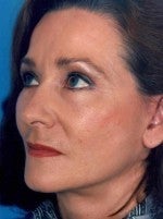 Facelift 1047931