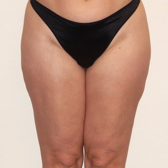45 year old woman treated with Liposuction after 3684906