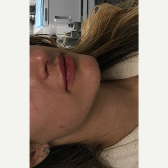 25-34 year old woman treated with Restylane Silk after 3837027
