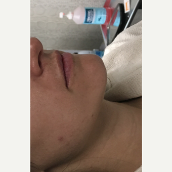 25-34 year old woman treated with Restylane Silk before 3837027