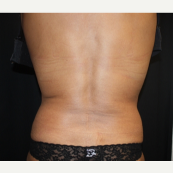 55-64 year old woman treated with CoolSculpting after 2587653