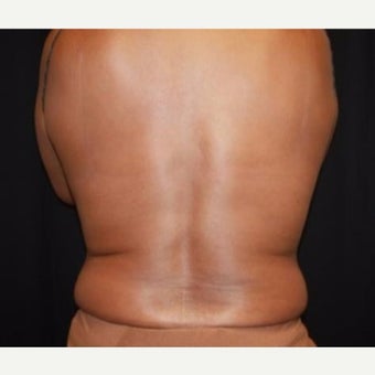 55-64 year old woman treated with CoolSculpting before 2587653