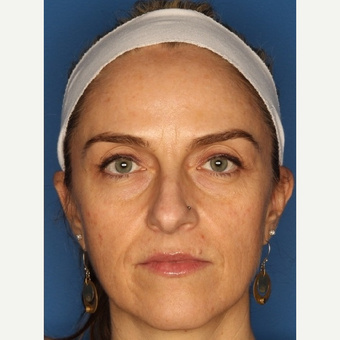 35-44 year old woman treated with Botox after 3711633