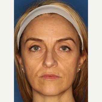 35-44 year old woman treated with Botox before 3711633