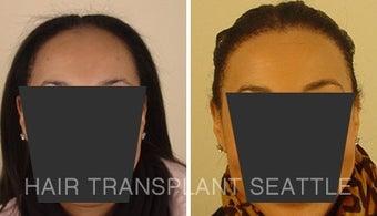 Female with Traction Alopecia and Hair Transplant Repair before 1578511