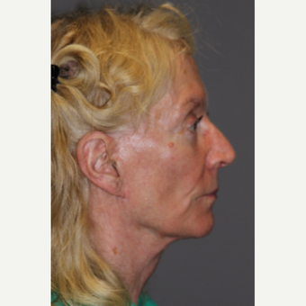 65-74 year old woman treated with Eyelid Surgery after 3286741