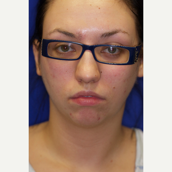 25-34 year old woman treated with Chin Liposuction before 3260031