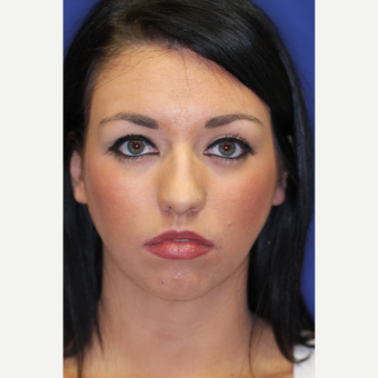 25-34 year old woman treated with Chin Liposuction after 3260031