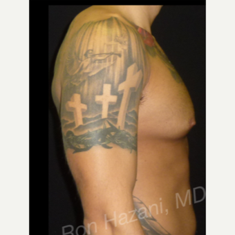 35-44 year old man treated with Male Breast Reduction before 3351894