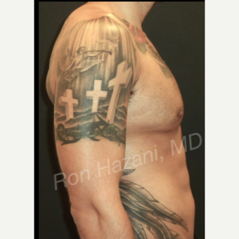 35-44 year old man treated with Male Breast Reduction after 3351894
