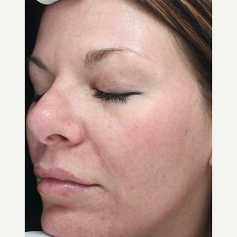 Halo Laser after 1833368