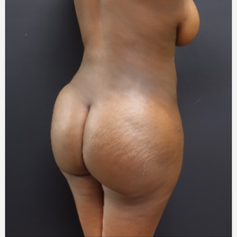 25-34 year old woman treated with Fat Transfer after 3363849