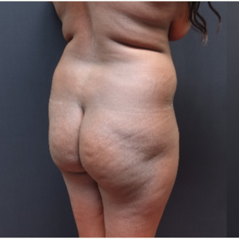 25-34 year old woman treated with Fat Transfer before 3363849