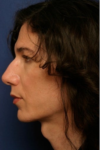 45-54 year old woman treated with Facial Feminization Surgery 1790512