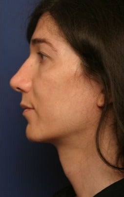 45-54 year old woman treated with Facial Feminization Surgery 1790512