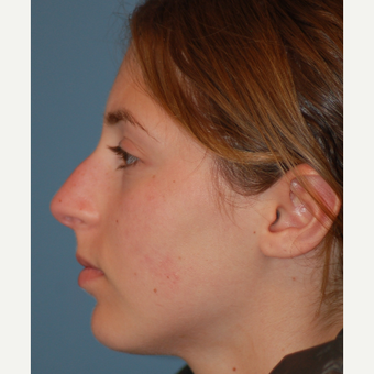 17 or under year old woman treated with Rhinoplasty before 3505809