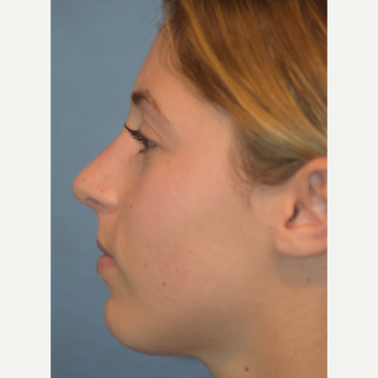 17 or under year old woman treated with Rhinoplasty after 3505809