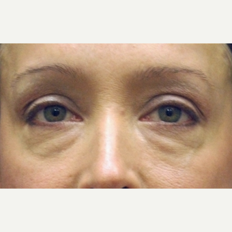 35-44 year old woman treated with Eyelid Surgery before 3783048