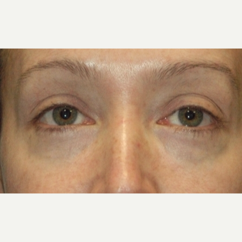 35-44 year old woman treated with Eyelid Surgery after 3783048