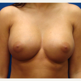 18-24 year old woman treated with Breast Implants after 3669366