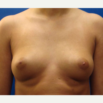 18-24 year old woman treated with Breast Implants before 3669366