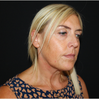45-54 year old woman treated with Facelift before 3493985