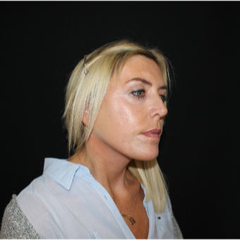 45-54 year old woman treated with Facelift after 3493985