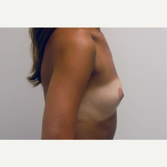 35-44 year old woman treated with Breast Augmentation before 3377559