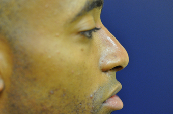Non Surgical Nose Job after 686478