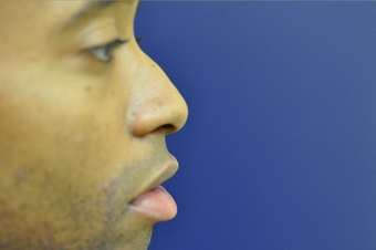 Non Surgical Nose Job before 686478