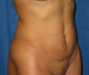 35 year old woman treated with Tummy Tuck before 2285641