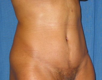 35 year old woman treated with Tummy Tuck after 2285641