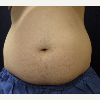 18-24 year old man treated with CoolSculpting before 3680152