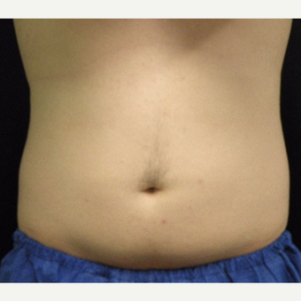 18-24 year old man treated with CoolSculpting after 3680152